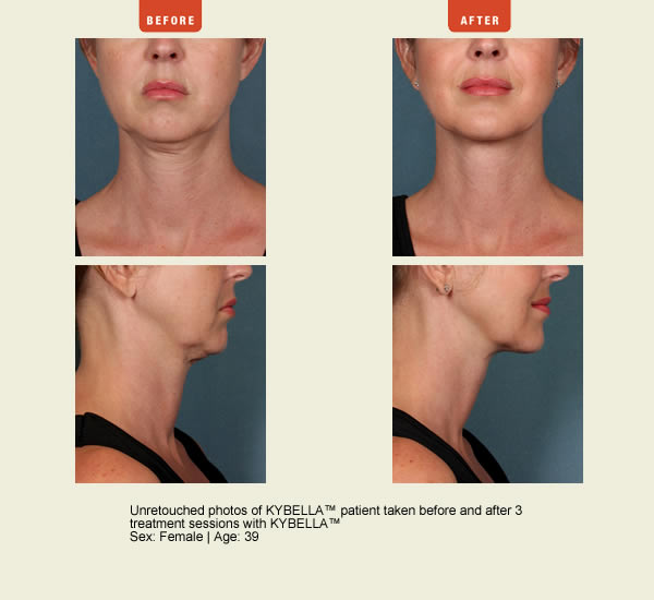 Juvederm Photo