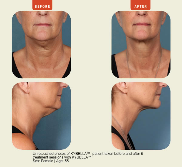 Juvederm Photo