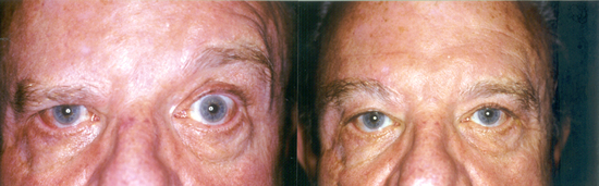 Brow Lift Photo