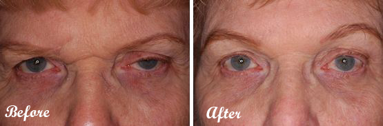 Forehead lift Photo