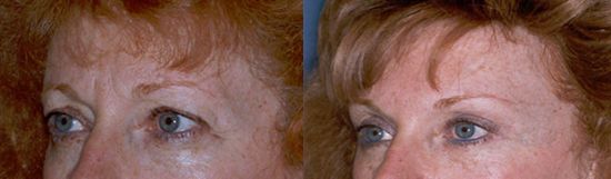 botox patient photo