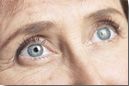 Brow lift photos