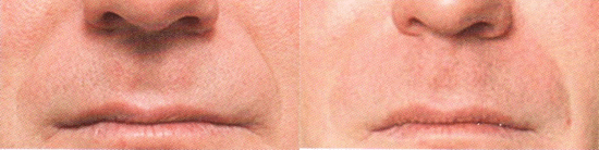 Juvederm Photo