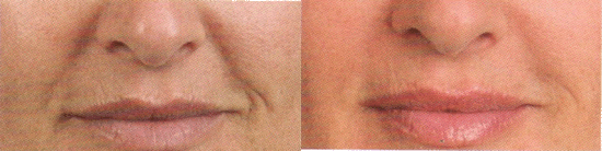 Juvederm Photo