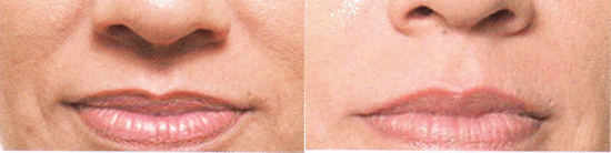 Juvederm Photo