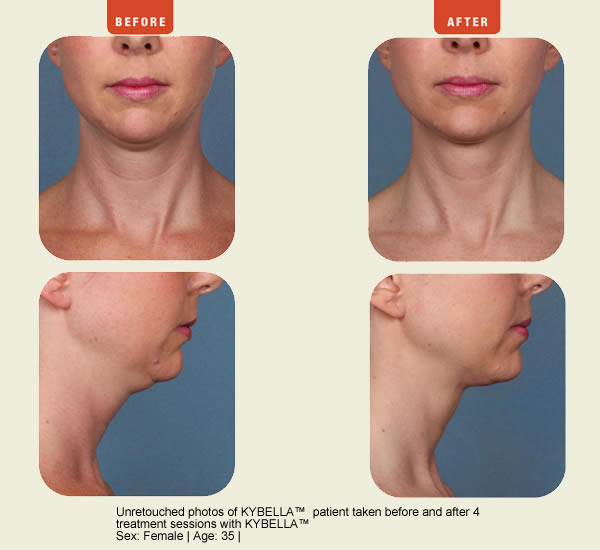 Juvederm Photo