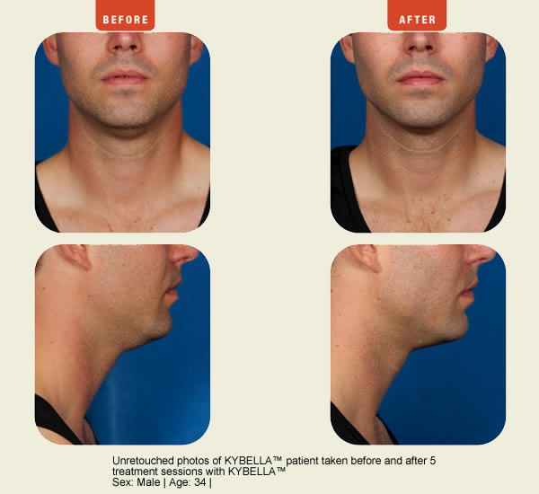 Juvederm Photo
