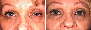 ptosis photos