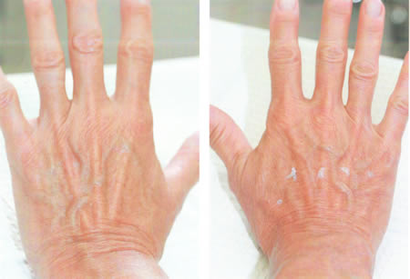 hand rejuvination photo