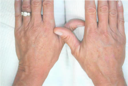 hand rejuvination photo