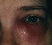 infected tear duct