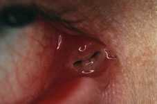 infected ear duct